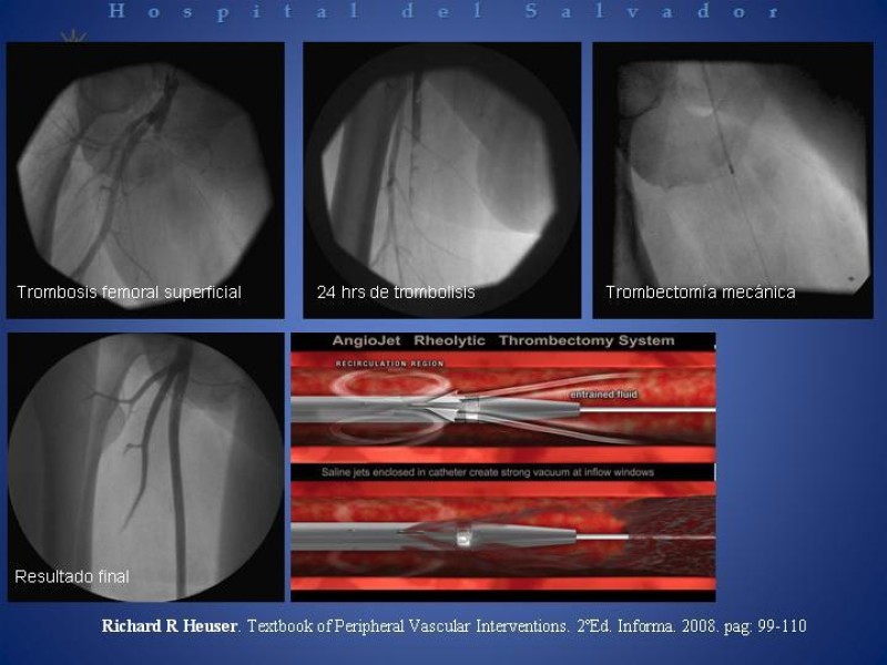 Diapositiva 21 de Isquemia arterial aguda en EEII