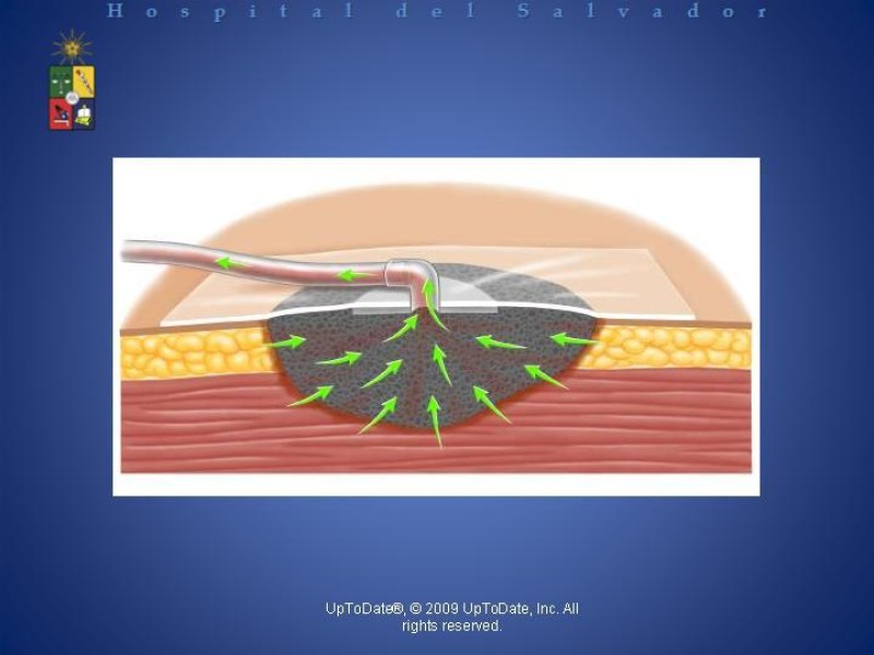 Diapositiva 23 de Vacuum-Assisted Closure en laparotomía. 