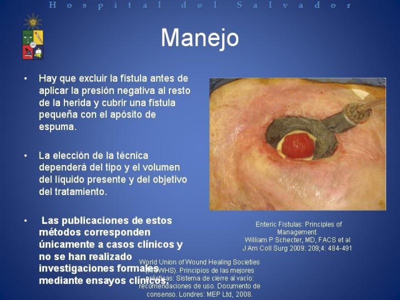 Diapositiva 32 de Vacuum-Assisted Closure en laparotomía. 