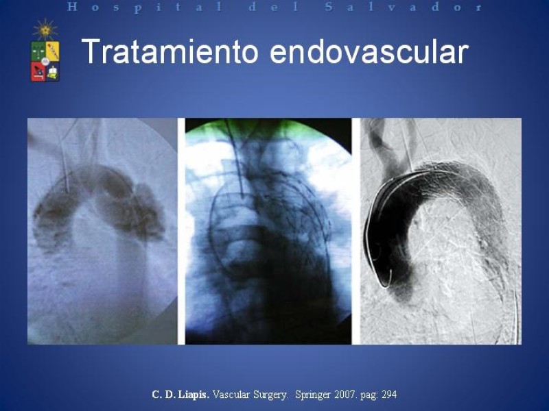 Diapositiva 18 de Tratamiento de la Disección Aortica