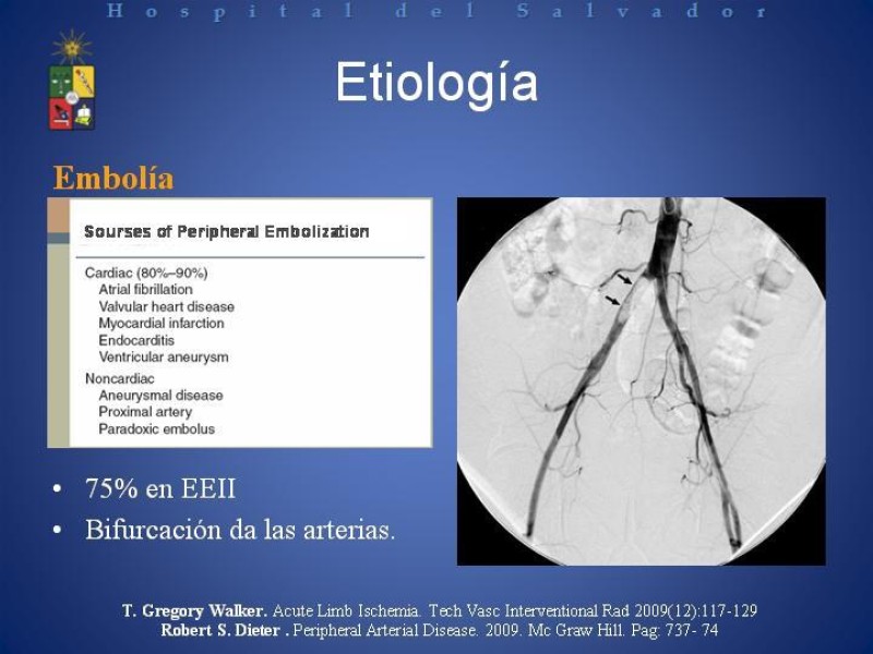 Diapositiva 4 de Isquemia arterial aguda en EEII