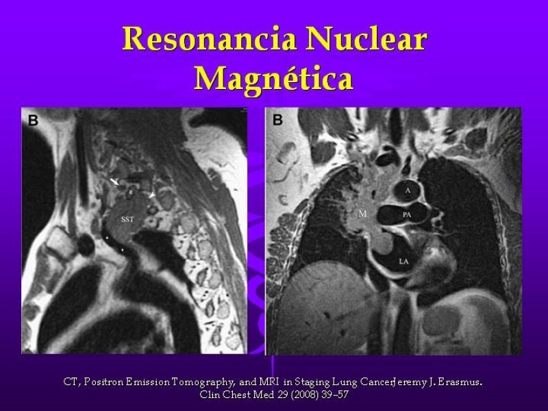 Diapositiva 28 de Cáncer de pulmón