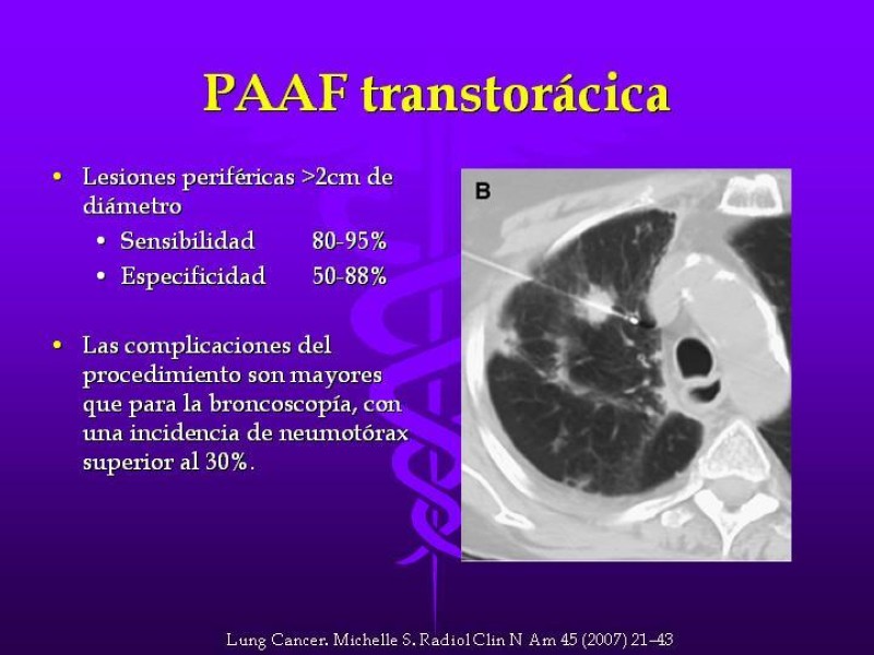 Diapositiva 32 de Cáncer de pulmón