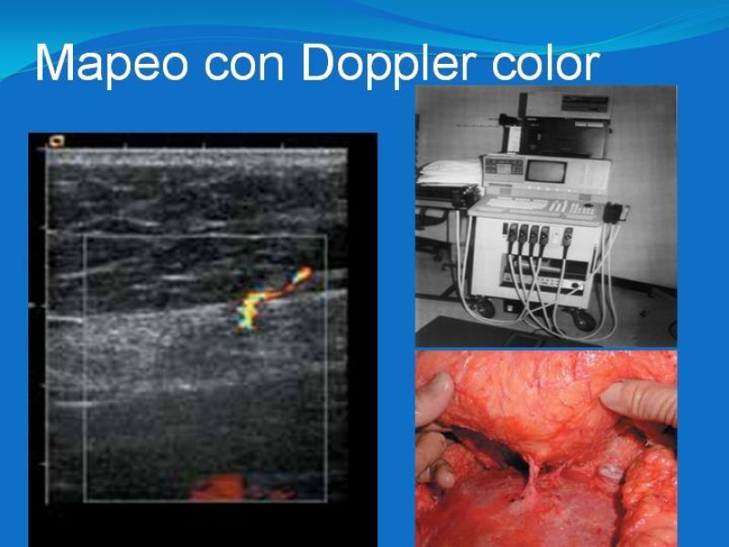 Diapositiva 14 de Colgajos estilo libre: Aplicación en cirugía reparadora
