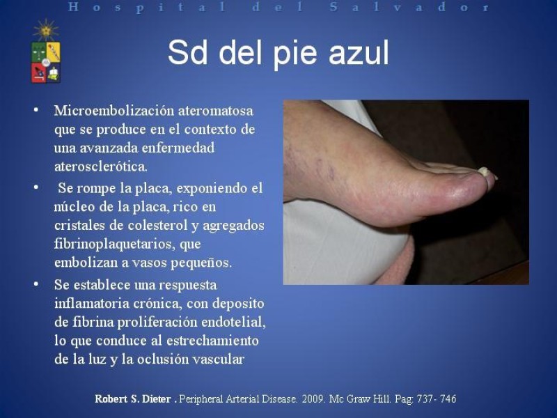 Diapositiva 12 de Isquemia arterial aguda en EEII