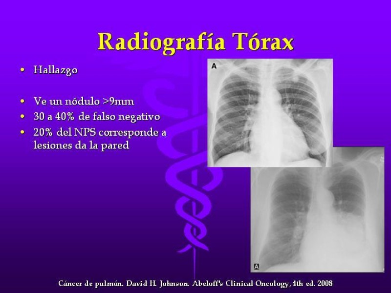 Diapositiva 26 de Cáncer de pulmón
