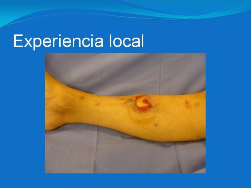 Diapositiva 40 de Colgajos estilo libre: Aplicación en cirugía reparadora