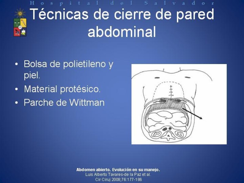 Diapositiva 12 de Vacuum-Assisted Closure en laparotomía. 