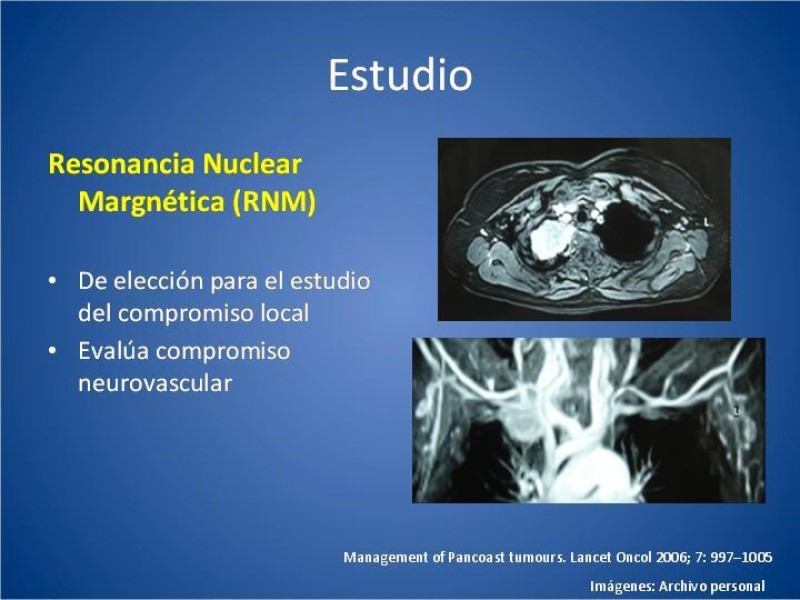 Diapositiva 11 de Tumor de Pancoast