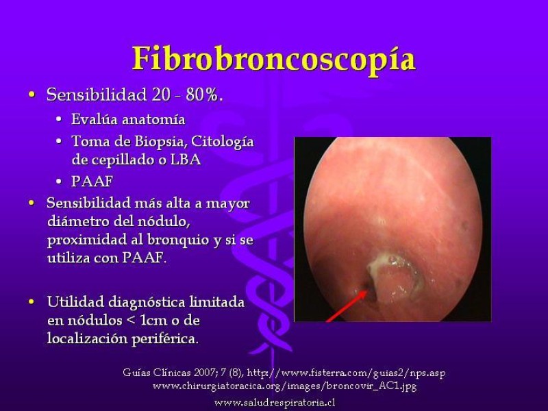Diapositiva 31 de Cáncer de pulmón