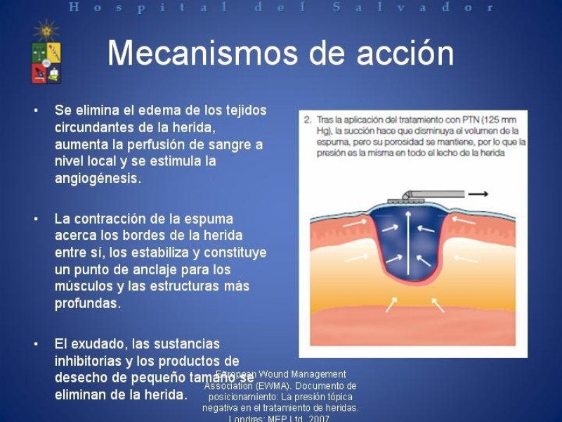 Diapositiva 21 de Vacuum-Assisted Closure en laparotomía. 