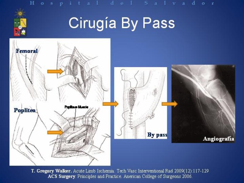 Diapositiva 25 de Isquemia arterial aguda en EEII