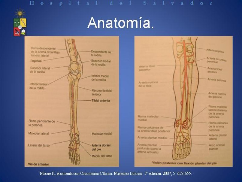 Diapositiva 4 de Amputación Infracondilea.