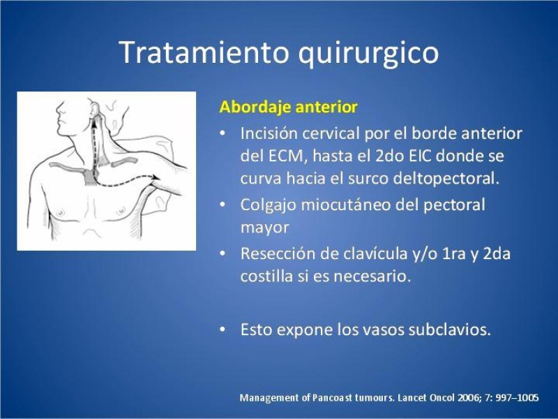 Diapositiva 20 de Tumor de Pancoast