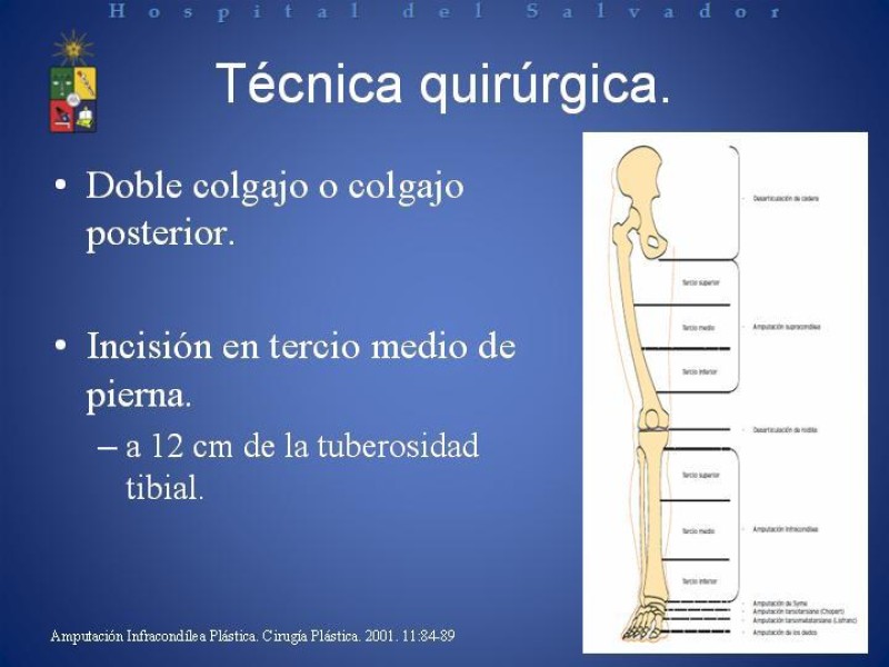 Diapositiva 7 de Amputación Infracondilea.