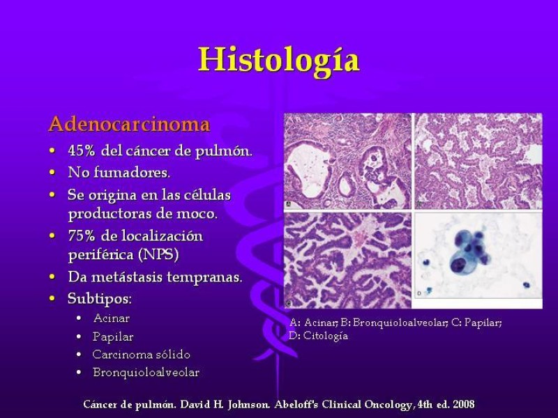 Diapositiva 20 de Cáncer de pulmón