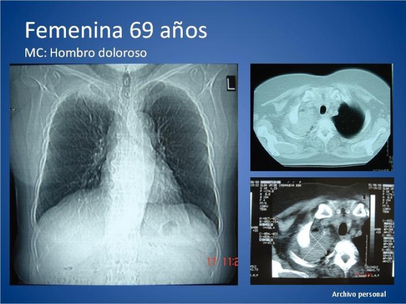 Diapositiva 23 de Tumor de Pancoast