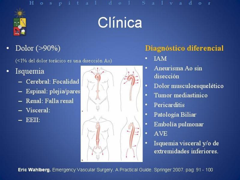 Diapositiva 7 de Tratamiento de la Disección Aortica