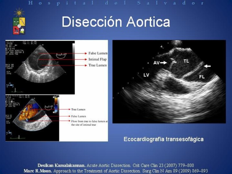 Diapositiva 8 de Tratamiento de la Disección Aortica