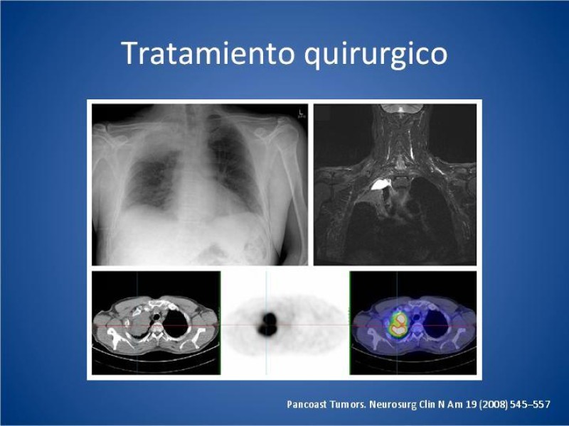 Diapositiva 21 de Tumor de Pancoast