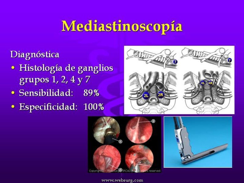 Diapositiva 29 de Cáncer de pulmón