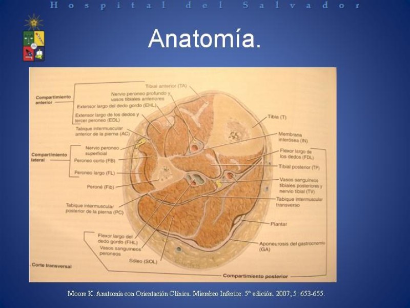 Diapositiva 5 de Amputación Infracondilea.