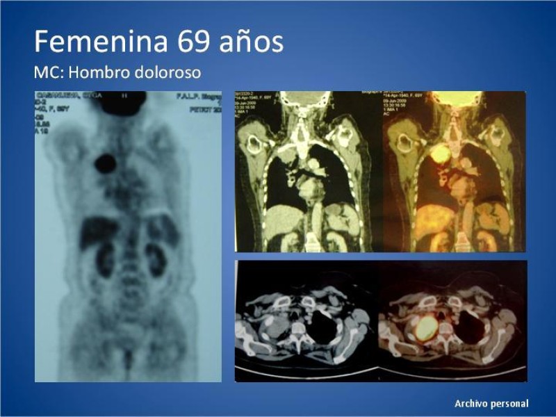 Diapositiva 24 de Tumor de Pancoast