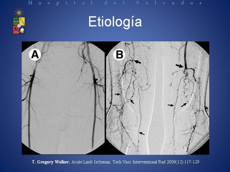 Diapositiva 3 de Isquemia arterial aguda en EEII