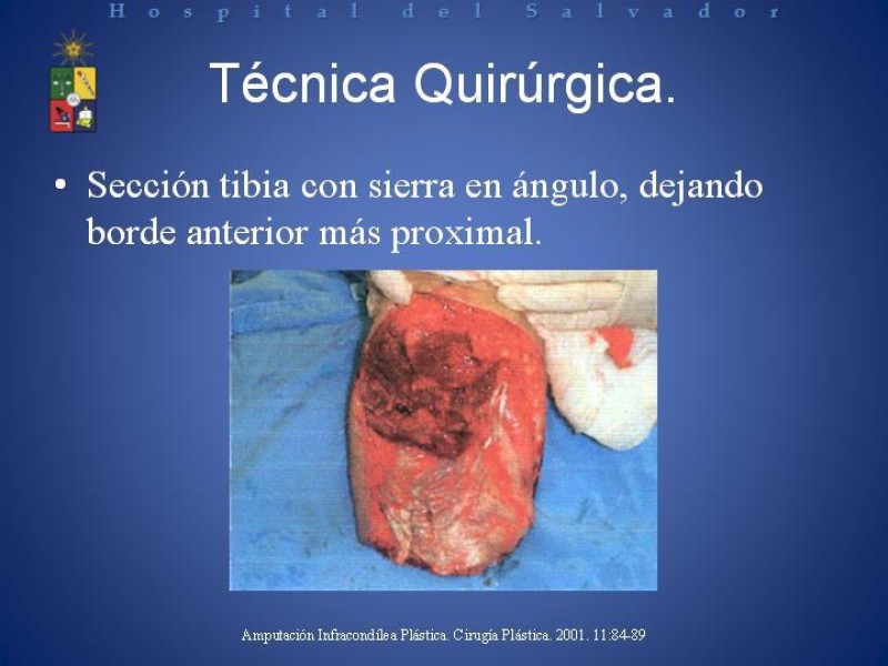 Diapositiva 11 de Amputación Infracondilea.