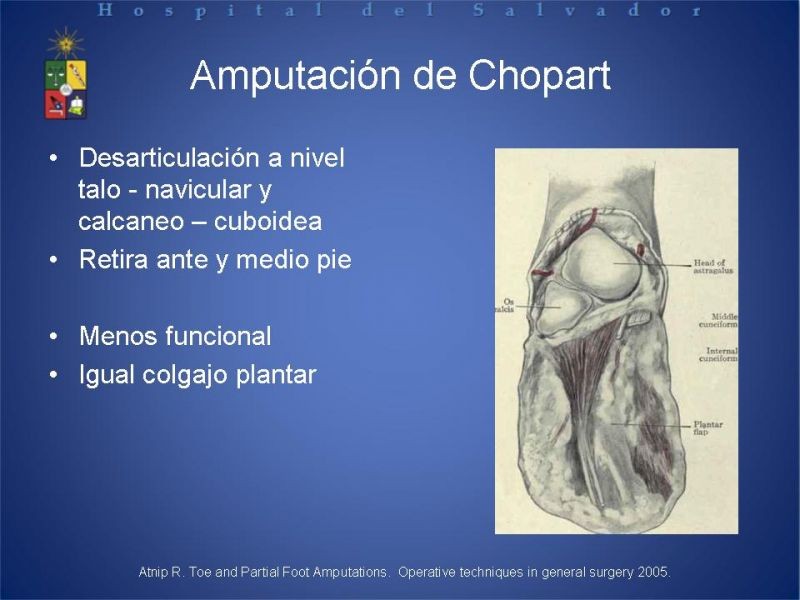 Diapositiva 34 de Amputaciones de extremidades inferiores