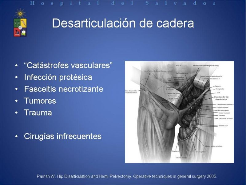 Diapositiva 47 de Amputaciones de extremidades inferiores