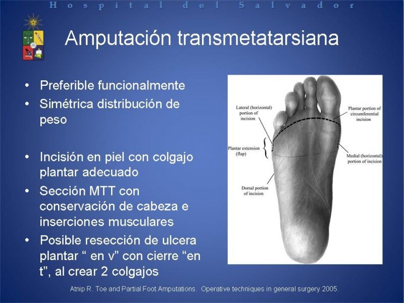 Diapositiva 29 de Amputaciones de extremidades inferiores