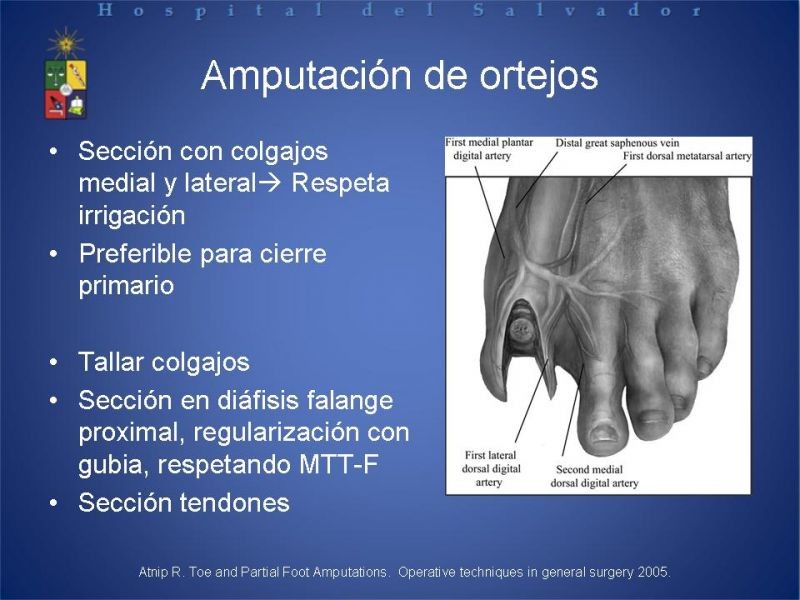 Diapositiva 20 de Amputaciones de extremidades inferiores