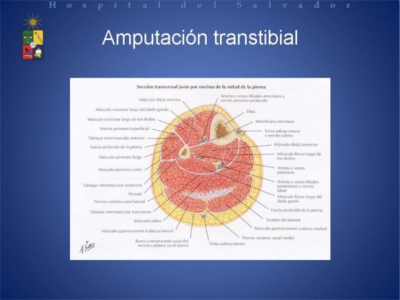Diapositiva 40 de Amputaciones de extremidades inferiores