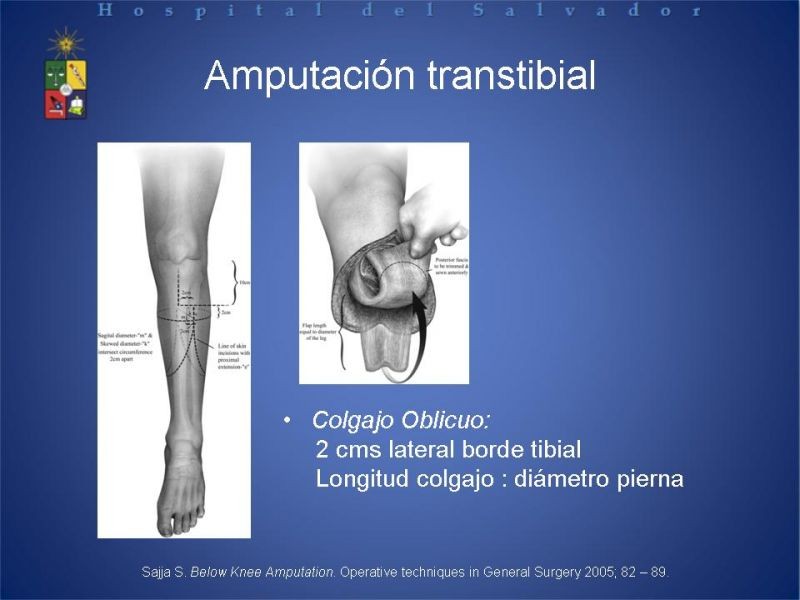 Diapositiva 42 de Amputaciones de extremidades inferiores
