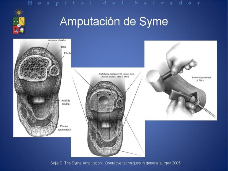 Diapositiva 37 de Amputaciones de extremidades inferiores