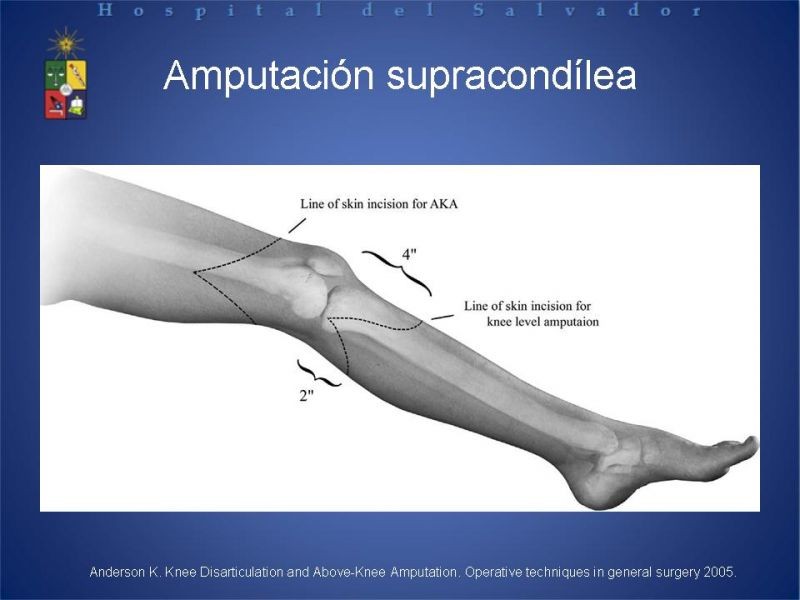 Diapositiva 44 de Amputaciones de extremidades inferiores