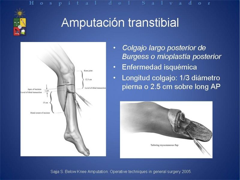 Diapositiva 41 de Amputaciones de extremidades inferiores