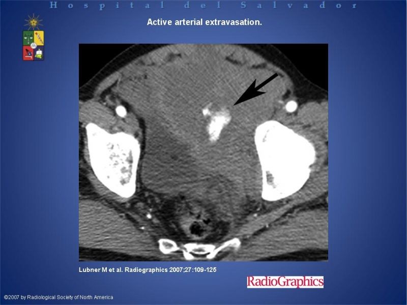 Diapositiva 14 de Trauma de pelvis