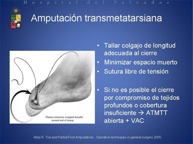 Diapositiva 31 de Amputaciones de extremidades inferiores