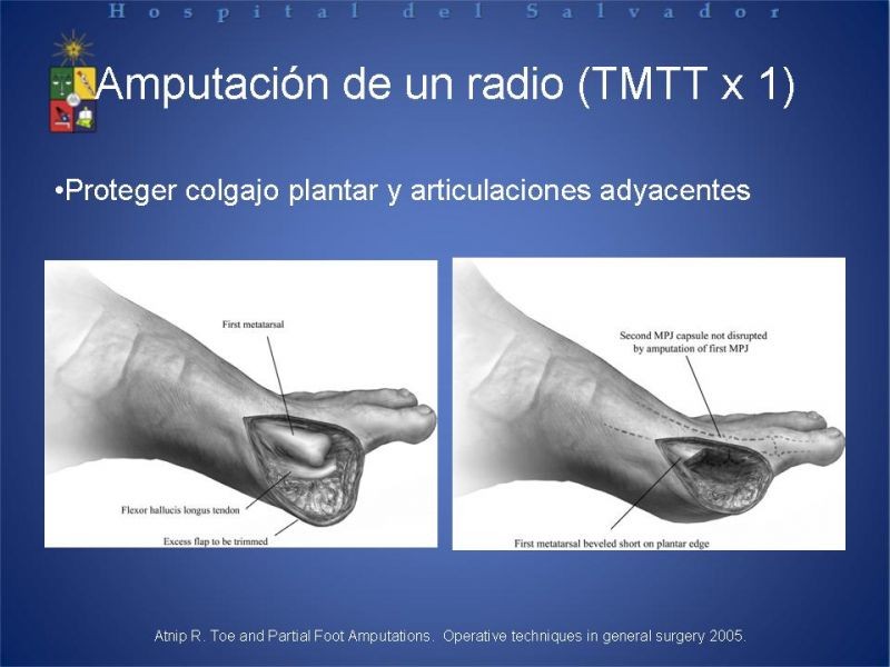 Diapositiva 24 de Amputaciones de extremidades inferiores