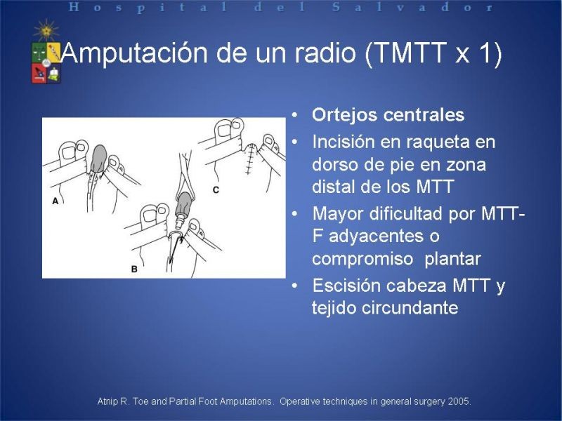 Diapositiva 25 de Amputaciones de extremidades inferiores