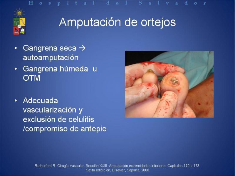 Diapositiva 18 de Amputaciones de extremidades inferiores