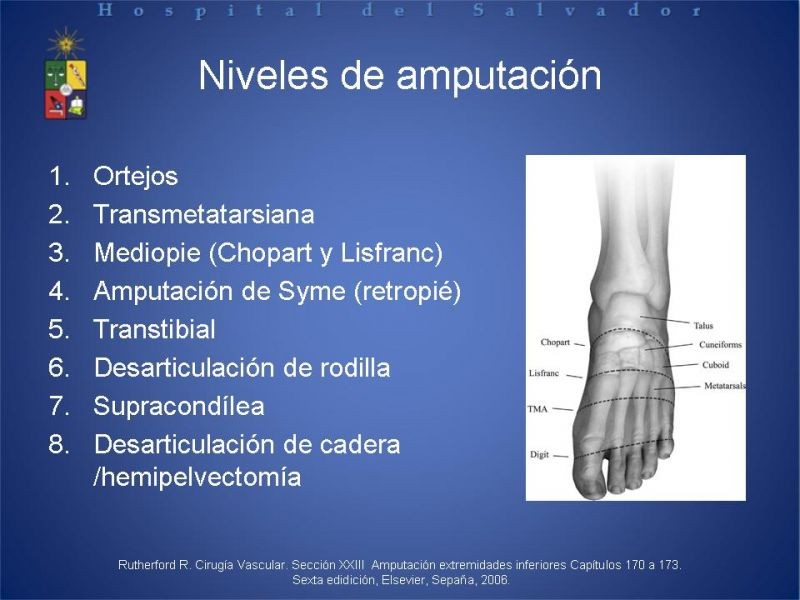 Diapositiva 16 de Amputaciones de extremidades inferiores
