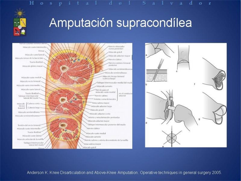 Diapositiva 46 de Amputaciones de extremidades inferiores