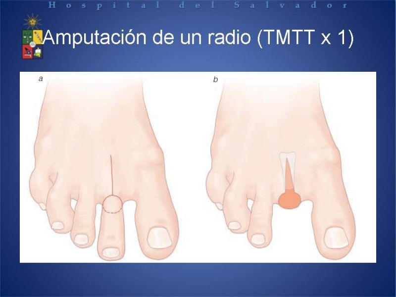 Diapositiva 26 de Amputaciones de extremidades inferiores