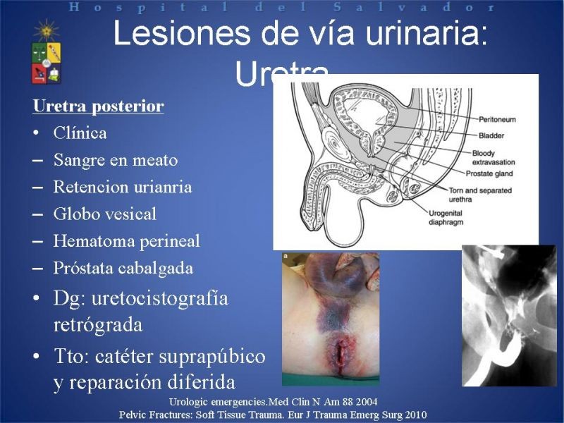 Diapositiva 17 de Trauma de pelvis