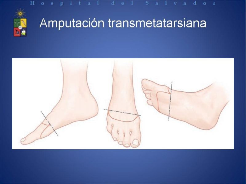 Diapositiva 30 de Amputaciones de extremidades inferiores