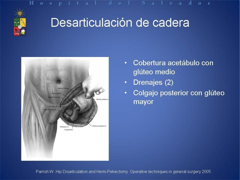 Diapositiva 48 de Amputaciones de extremidades inferiores