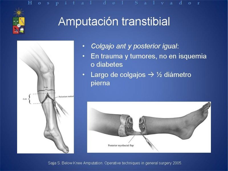 Diapositiva 39 de Amputaciones de extremidades inferiores